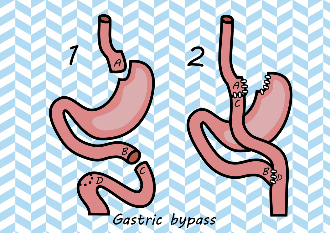 Gastric Bypass